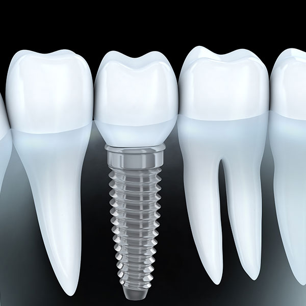 人工植牙<span>Implant</span>
